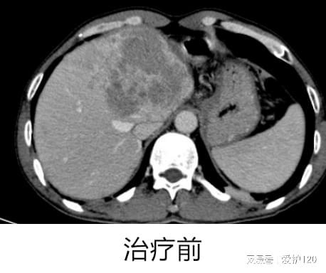 肝癌晚期最新重大突破，希望之光照亮生命之路